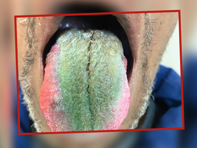 ¡Con los pelos en la boca! Vello verde le brota en lengua de un fumador; así fue cómo le salió
